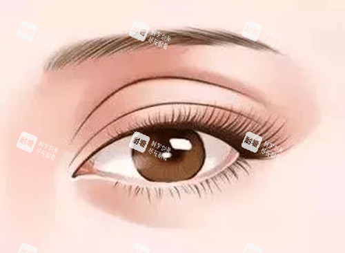 雙眼皮修復卡通示意圖