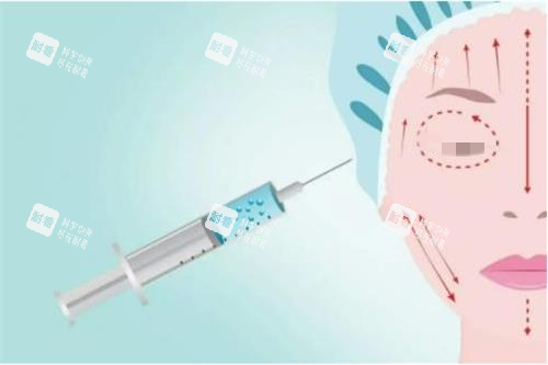 注射玻尿酸示意圖 注射玻尿酸示意圖