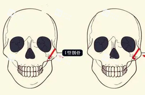 顴骨磨骨整形卡通示意圖