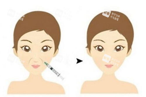 注射填充面部法令紋前后對(duì)比卡通示意圖