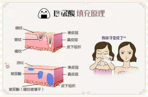 玻尿酸注射填充原理動(dòng)畫(huà)演示圖