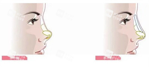 隆鼻手術(shù)前后對(duì)比