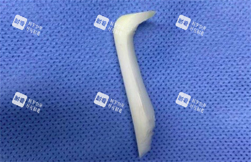 取出的隆鼻假體