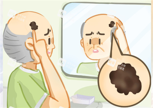 黑色素瘤怎么辦