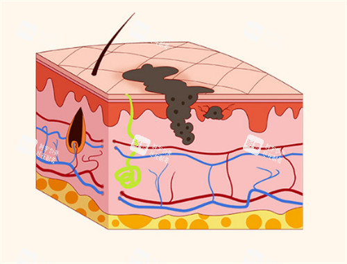 黑色素瘤在皮膚下的層次