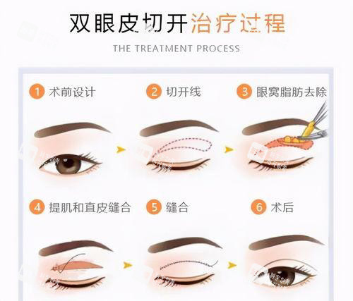 雙眼皮手術方法過程圖