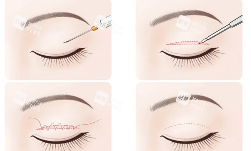 全切雙眼皮簡易術后流程