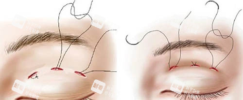 埋線(xiàn)雙眼皮方式圖