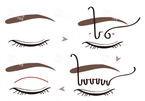 埋線(xiàn)雙眼皮手術(shù)過(guò)程