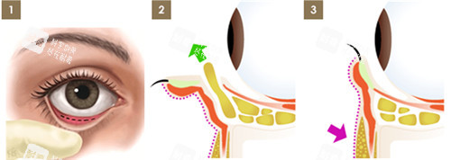 眼袋手術圖解