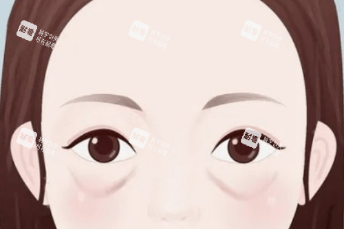 眼袋卡通展示圖