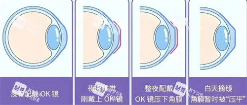 角膜塑形鏡佩戴前后對比圖 角膜塑形鏡佩戴前后對比圖