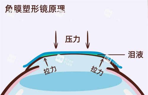 角膜塑形鏡原理 角膜塑形鏡原理