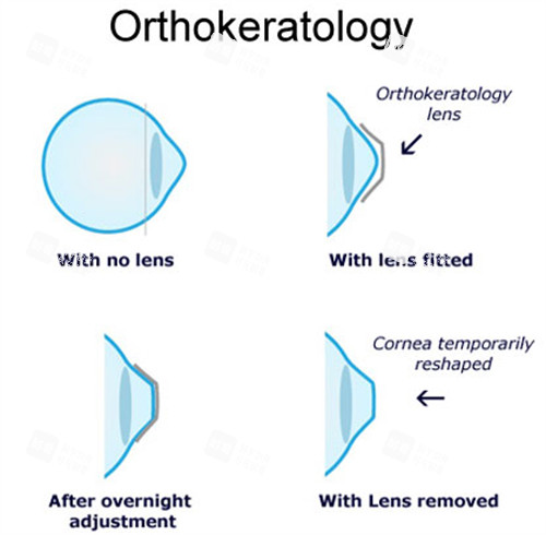 角膜塑形鏡工作流程 角膜塑形鏡工作流程