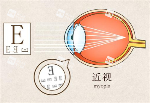 近視視物時(shí)的樣子圖解