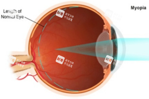 近視圖示 近視圖示
