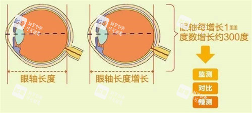眼軸長度與近視 眼軸長度與近視