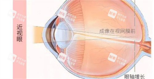 近視眼的成像 近視眼的成像