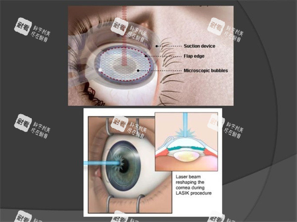 近視眼手術(shù)照片 近視眼手術(shù)照片