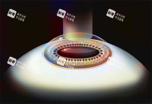 smart激光近視手術(shù)演示 smart激光近視手術(shù)演示