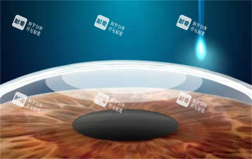 smart全激光近視手術(shù) smart全激光近視手術(shù)