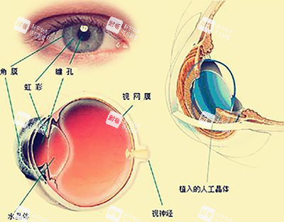 三焦點(diǎn)人工晶體植入手術(shù)示意圖 三焦點(diǎn)人工晶體植入手術(shù)示意圖