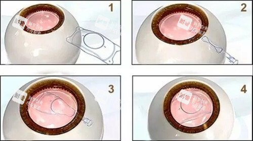 近視矯正人工晶體植入漫畫示意圖 近視矯正人工晶體植入漫畫示意圖