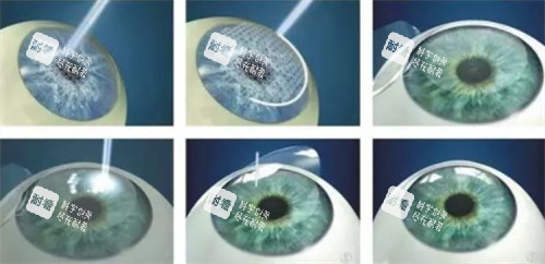 全飛秒近視手術(shù)過(guò)程詳細(xì)圖解