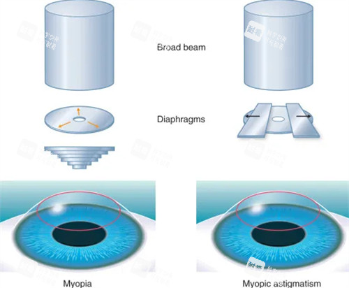 近視手術(shù)流程
