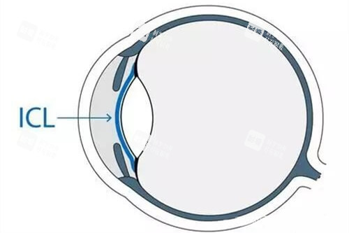 ICL晶體植入近視眼手術眼球位置示意圖