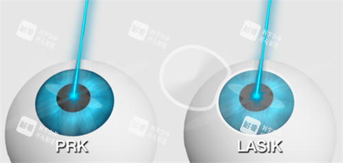 不同的近視手術