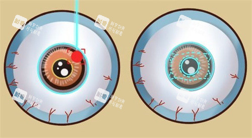 激光類近視手術和ICL晶體植入手術