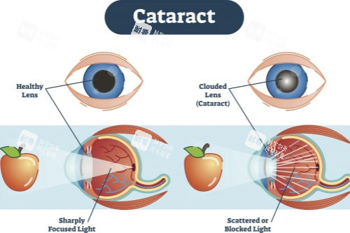正常眼睛與白內(nèi)障眼睛視物對(duì)比圖
