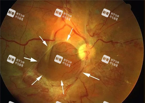 視網(wǎng)膜脫落細節(jié)表現(xiàn)圖