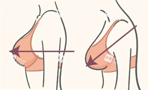 縮胸手術(shù)術(shù)前術(shù)后