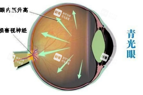 青光眼概念圖