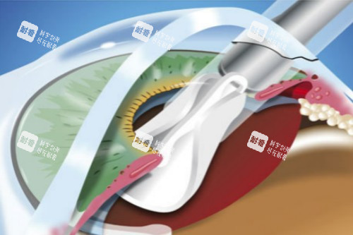 白內(nèi)障超聲乳化術
