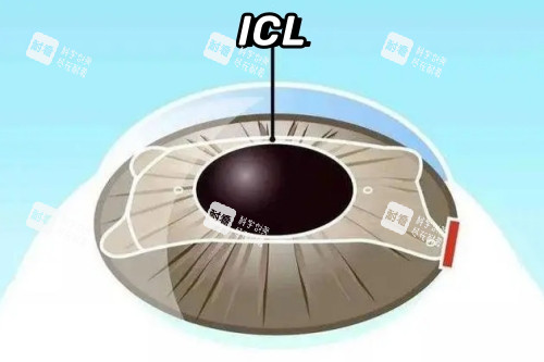 ICL晶體植入卡通一覽圖