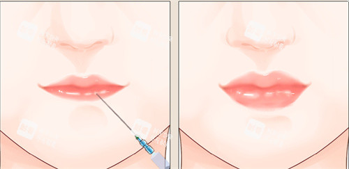 注射豐唇手術