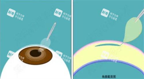 激光近視手術(shù)過(guò)程圖解 激光近視手術(shù)過(guò)程圖解