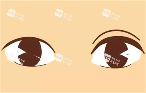 雙眼皮手術(shù)的前后對(duì)比