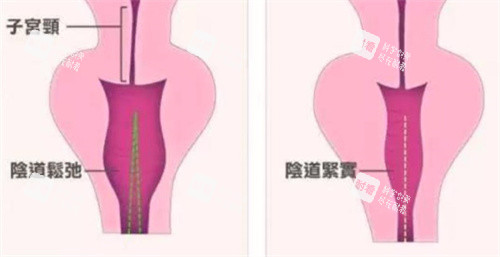 生物束帶緊縮術(shù)對比