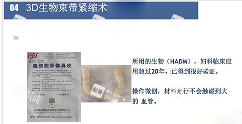 3d生物束帶緊縮術(shù)材料講解