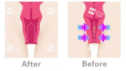 陰道緊縮對比圖