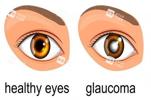 青光眼對(duì)比