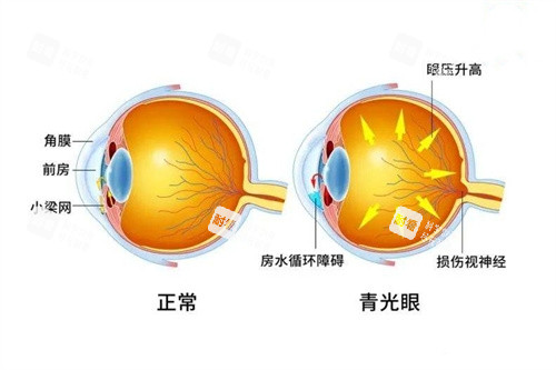 青光眼與正常眼對(duì)比