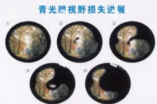 青光眼視野損失進(jìn)展展示圖