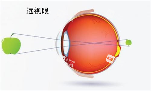 遠視眼睛的視力