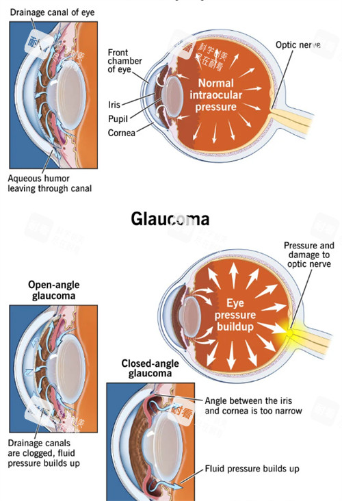 青光眼和正常眼睛眼壓不同