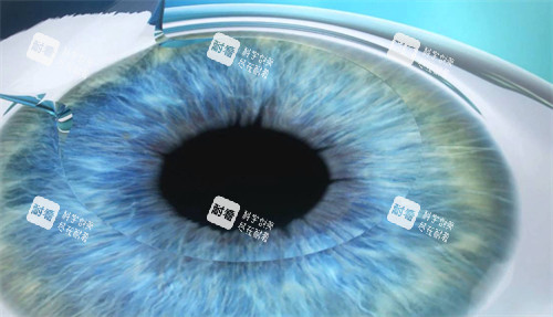 近視手術(shù)前眼睛制瓣